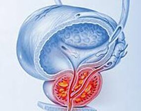 Prostatın prostatit ile iltihaplanması