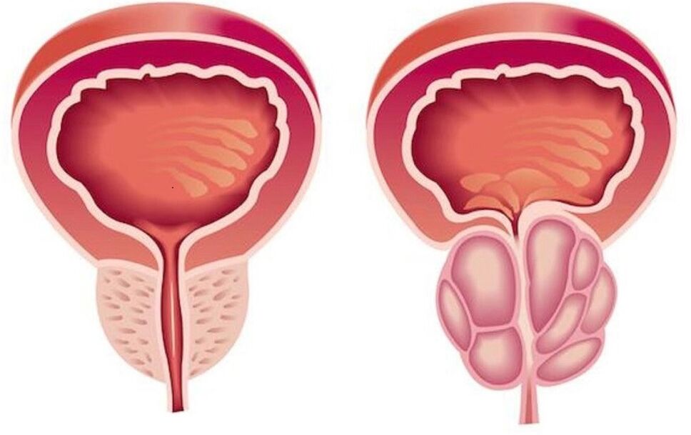 prostatit ile sağlıklı ve iltihaplı prostat